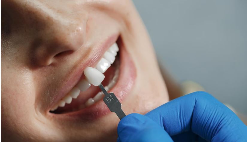 Композитные виниры: путь к идеальной улыбке